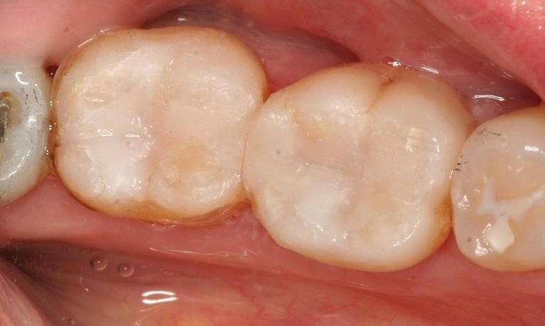 Posterior-Composite-After-Image