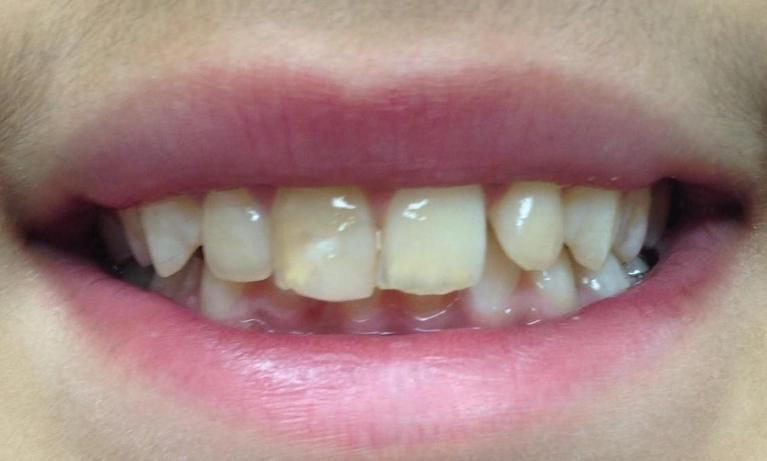 Anterior-Composites-Before-Image