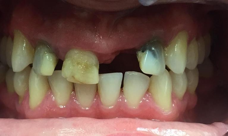Anterior-Implant-and-Crowns-Before-Image