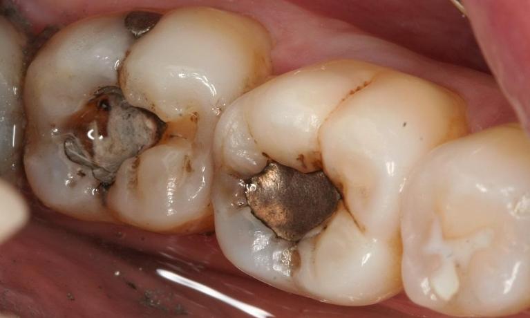 Posterior-Composite-Before-Image